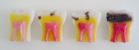 Da esquerda para a direita: Dente saudável - Dente com ponto superficial de cárie - Dente com cárie moderada - Dente com cárie avançada que necessita de tratamento de canal