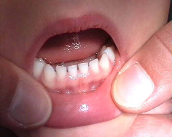 Featured image of post Dente Entramelado Infantil Escovar os dentes com bicarbonato n o substitui a escova o com uma pasta de dente regular