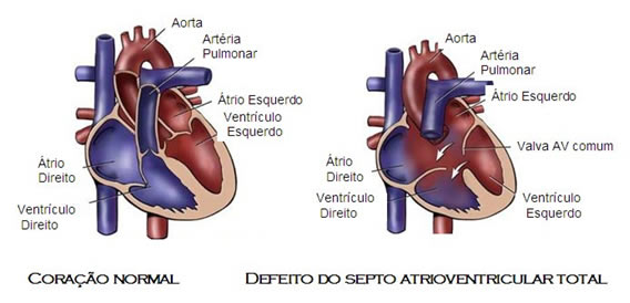 coracao-Defeito do Septo Atrioventricular