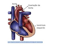 Coarctação da aorta