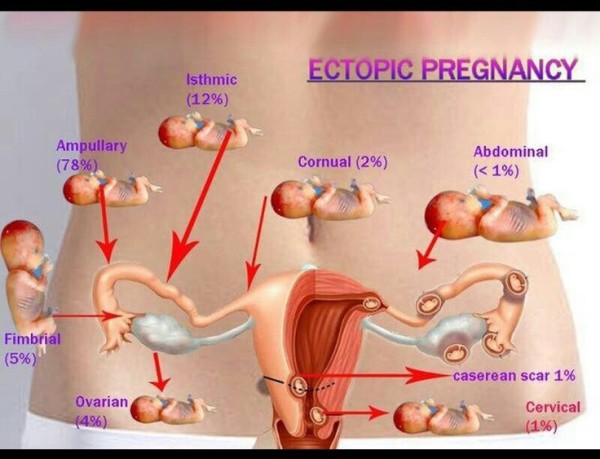 Nesta imagem do site www.newkidscenter.com é possível identificar os locais de implantação e a porcentagem de incidência por gravidez ectópica.